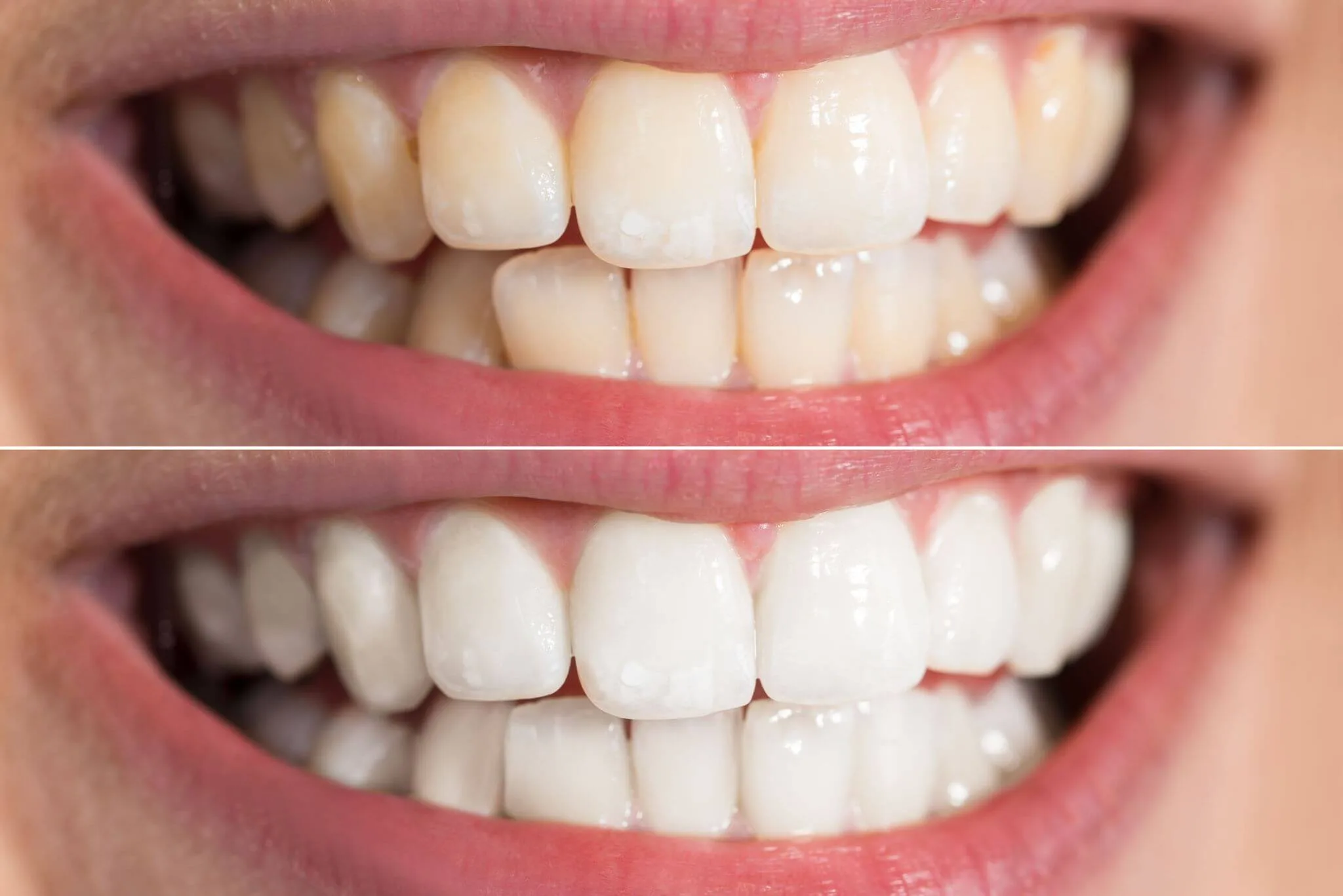 Clínicas de Blanqueamiento dental en El Salvador