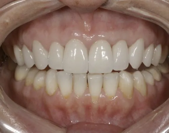 Ajuste y naturalidad de coronas dentales libres de metal