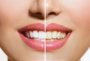 Clínicas de Blanqueamiento dental en El Salvador