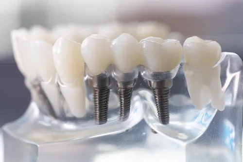 Evaluación de candidatos a implantes dentales en El Salvador