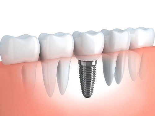 Implantes Dentales en El Salvador